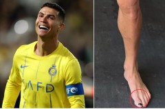 Ronaldo và Tyson sơn móng chân vệ sinh, phòng bệnh